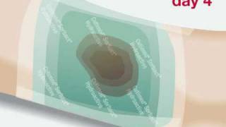 Cutimed Sorbact Hydroactive - How to use