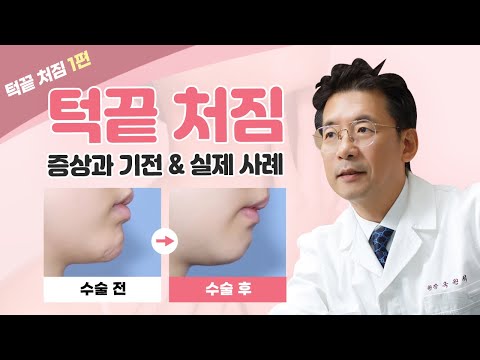 윤곽수술 부작용 발생 원인과  치료 사례