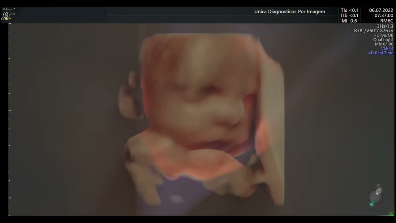 Ultrassom 4D HD Live - 09