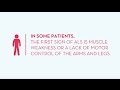 Signs And Symptoms Of ALS