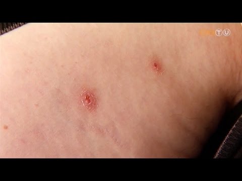 Kiütés férgekkel gyermekeknél, Kiütés férgekkel, A Magyarországon előforduló féregfertőzések