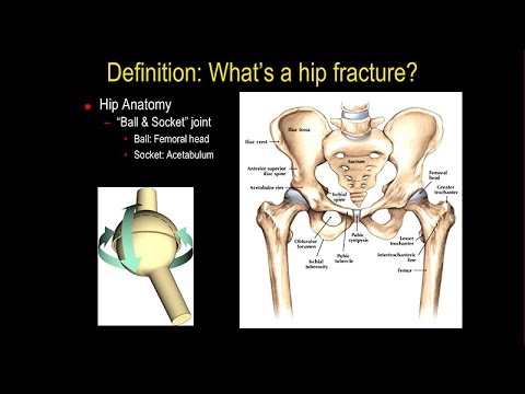 Hip Fractures: A Growing Epidemic