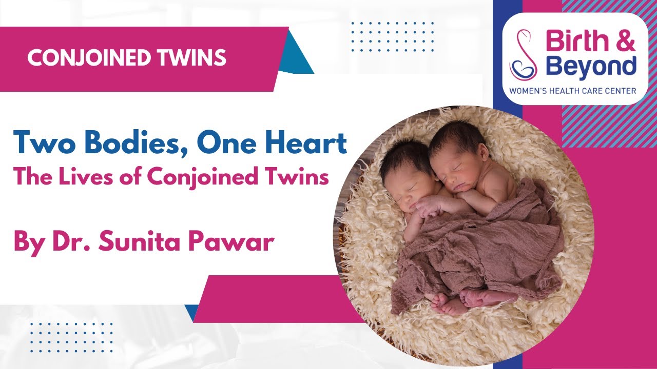 Inside the World of Conjoined Twins