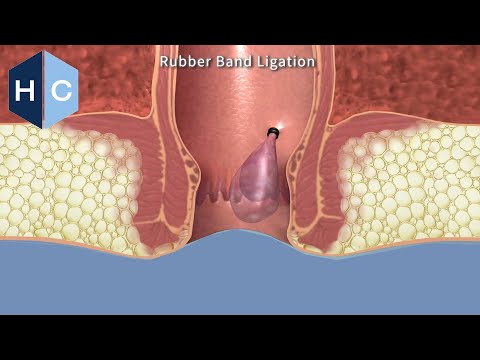 Office Treatment Of Hemorrhoids With Rubber Band Ligation