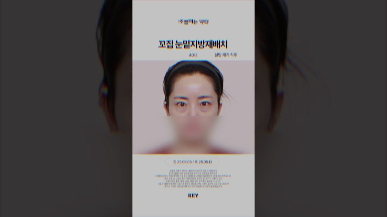 40대 꼬집눈밑지방재배치 대구키성형외과