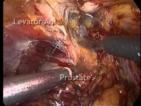 Laparoscopic Radical Prostatectomy - Accessory Pudental Arteries Protection