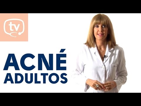 Cómo tratar el acné del adulto