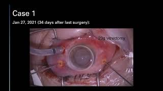 Traumatic Macular Holes: A Visual and Anatomic Outcome Study