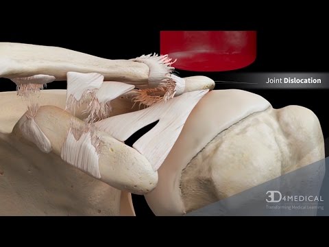 AC Joint Dislocation (Grade 3)