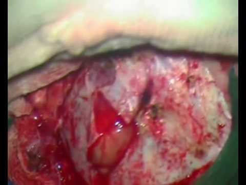 Stimulation wunder unterer Rücken Übung mit zervikaler Osteochondrose Video