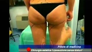 Chirurgia estetica Liposuzione senza bisturi