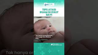 Cara Atasi Ruam di Kulit Bayi yang Perlu Diketahui Orangtua, Oleskan Air Susu Ibu di Kulit