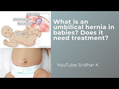 Umbilical hernia in babies-what is it? Does it need any treatment? Dr Sridhar K