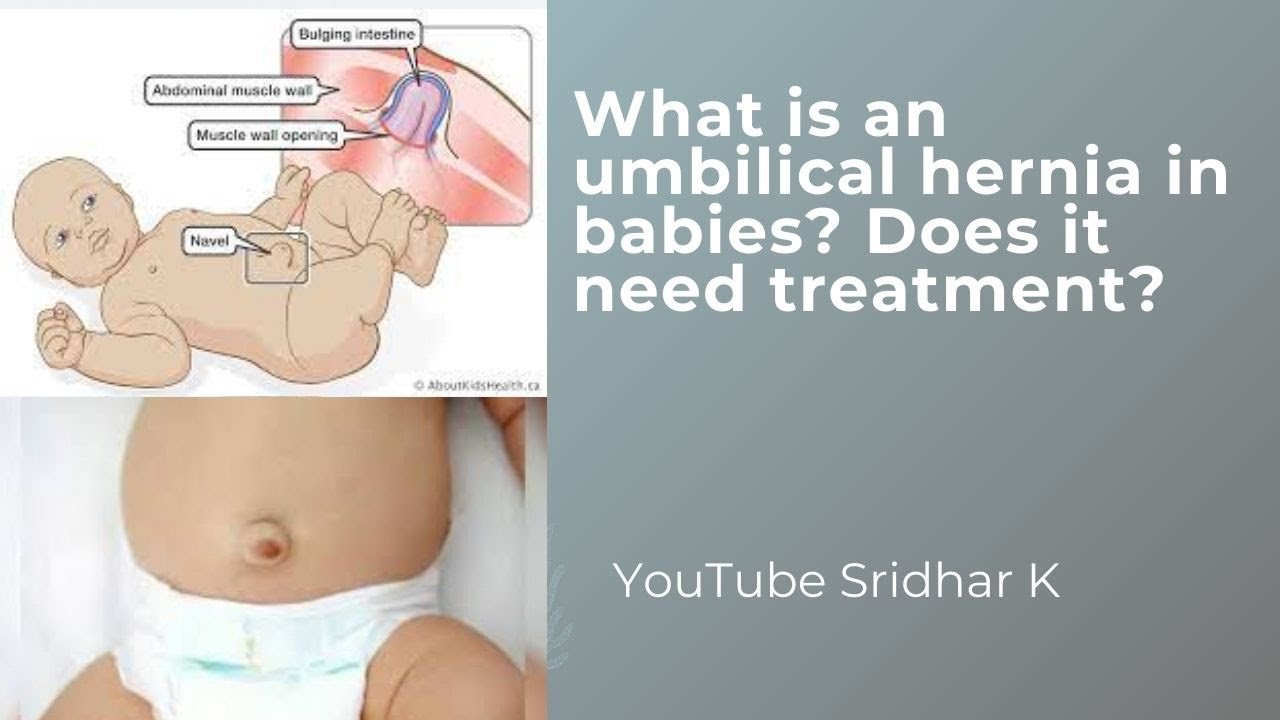 Umbilical hernia in babies-what is it Does it need any treatment #umbilicalhernia #umbilicalcord