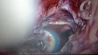Download Lagu Brain stem cavernoma Agung Budi Sutiono, MD, PhD Thumbnail