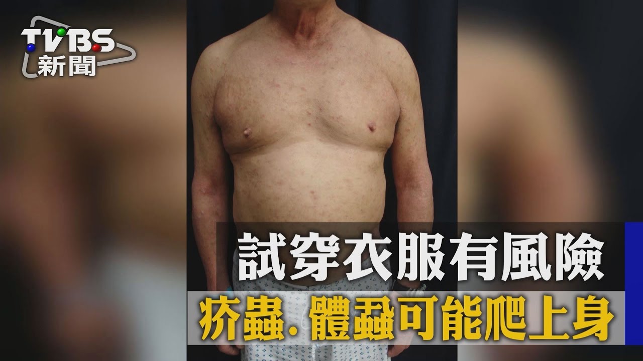 試穿衣服有風險 疥蟲、體蝨可能爬上身