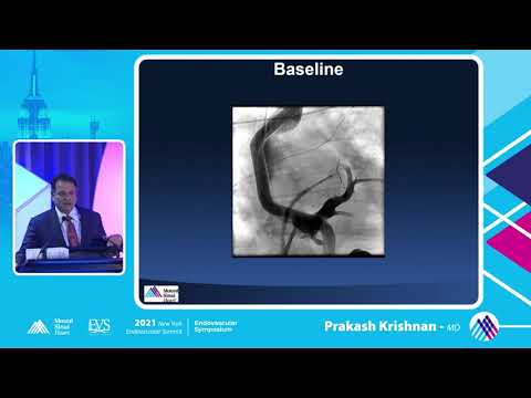 Complications and Bailouts Perforation Case 1 - Prakash Krishnan, MD