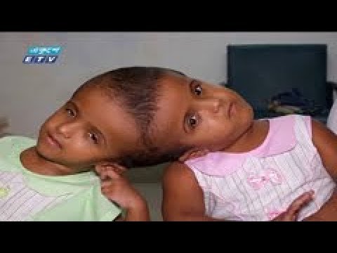 মাথা জোড়া লাগানো জমজের ২য় ধাপের অপারেশন সফল