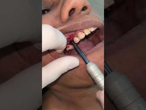 Pterygoid Path Finder