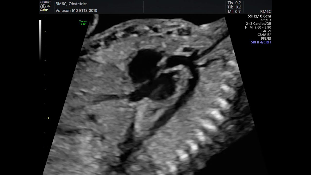 AVALIAÇAO DE CORAÇÃO E PULMÃO FETAL EM FETO DE 28 SEMANAS