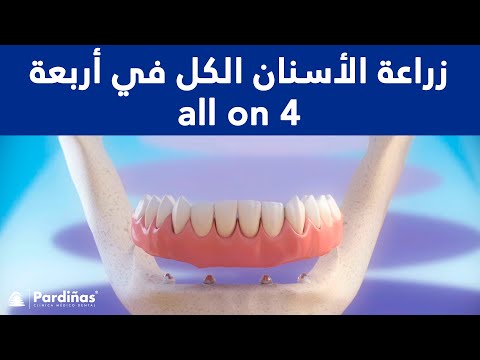 زراعة الأسنان الكل في أربعة – all on 4 ©
