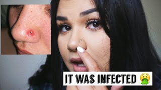 MY INFECTED NOSE PIERCING/ HOW I HEALED IT