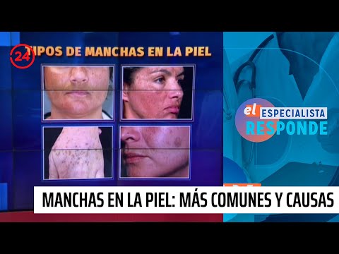 Manchas en la piel: Tipos más comunes y sus causas | 24 Horas TVN Chile