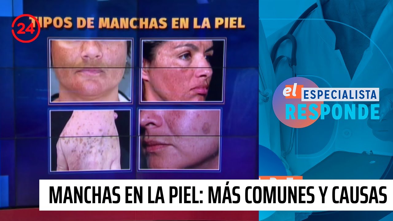 Manchas en la piel: Tipos más comunes y sus causas | 24 Horas TVN Chile