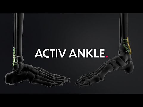 Activ Ankle range - Management of ankle fractures & osteotomies