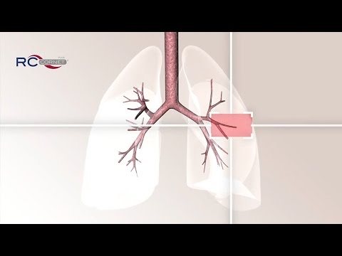 Wirkprinzip RC-Cornet® PLUS - für das Lösen von Bronchialschleim und Linderung Husten und Atemnot