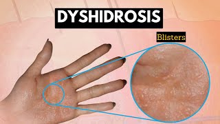 Dyshidrosis, Causes, Signs and Symptoms, Diagnosis and Treatment.