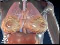 Breast Cancer Biopsy 3D Medical Animation