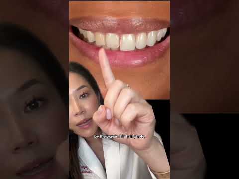 The truth about no prep veneers. Part 1 #veneer #veneers #dentist #smilemakeover #newsmile