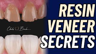 3 Secrets of STUNNING Resin Veneers Revealed! - PDP259