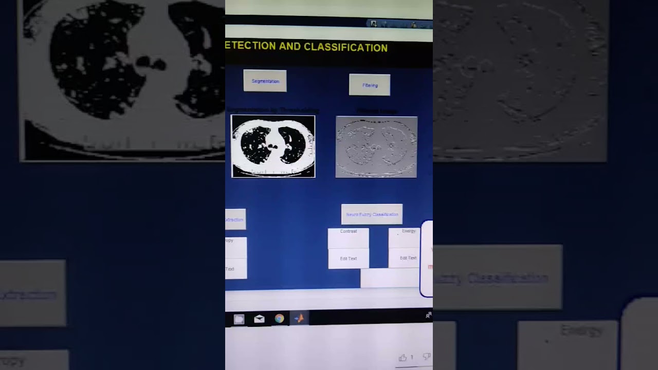 Lung cancer detection using Neural network and histogram dilation
