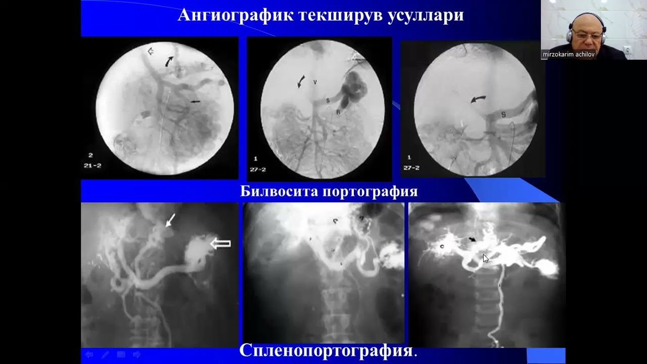 Portal gipertenziya va uning asoratlarini xirurgik davolash