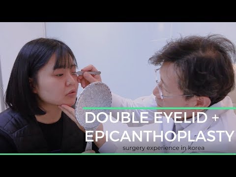 download lagu mp3 mp4 Epicanthoplasty Recovery, download lagu Epicanthoplasty Recovery gratis, unduh video klip Epicanthoplasty Recovery