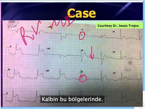 Amal Mattu'nun Haftalık EKG Vakası: Abstabil Bradikardi - 16 Eylül 2013