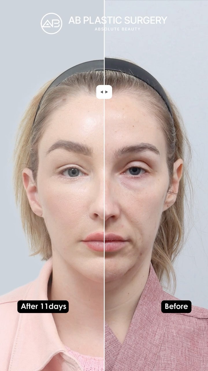 Her Transformation After Eye Surgery and Anti-Aging Surgery 😳