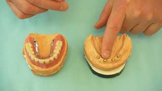 Locator denture - how does it work? Affordable dental treatment in Hungary