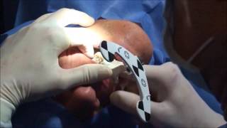 Navegacion para colocacion de implantes dentales - Enrique Amador Preciado