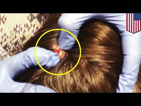 Analiza na koślawego operacja halyus Koślawe zniekształcenie u dzieci goleniach