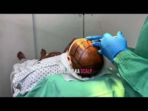 Is a hair transplant painful - AlKhaleej Clinics Karachi