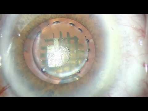 CATALY LASER CATARACT SURGERY