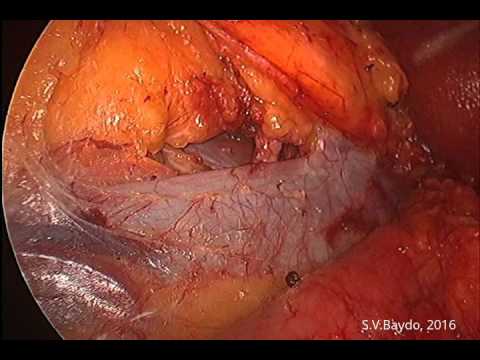 Zero Ischemia Laparoscopic Partial Nephrectomy 