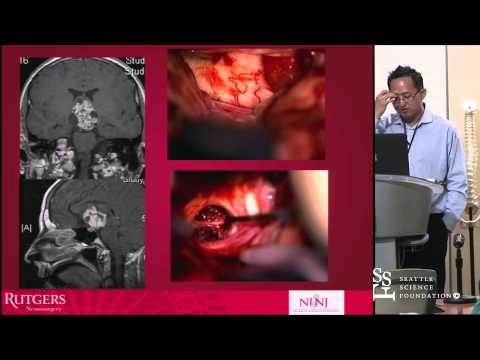 Endoscopic Endonasal Approach to the Anterior Skull Base and Parasellar Region by James K. Liu, M.D.