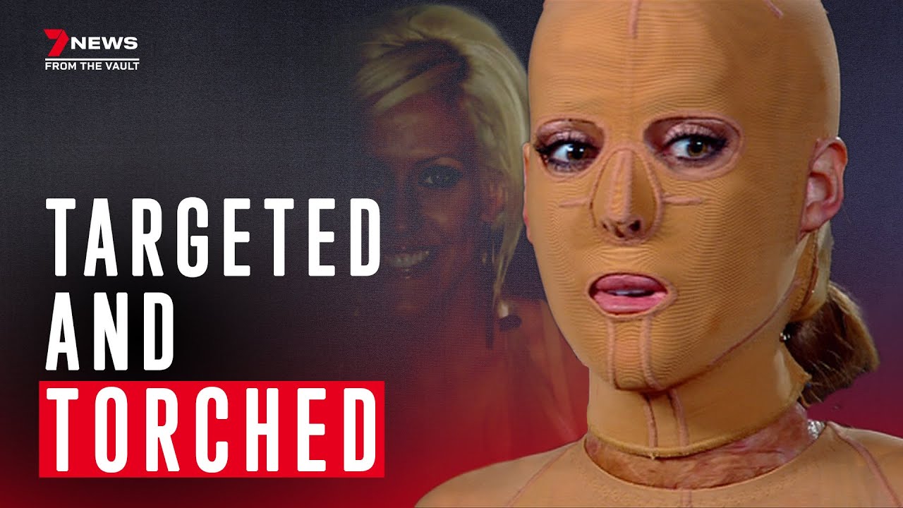 The girl behind the mask: set alight in a jealous rage and scarred for life | 7NEWS Spotlight