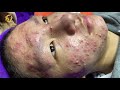 Treatment of acne tablets, pustules and blackheads (358) | Loan Nguyen