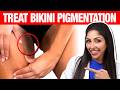 How To Treat Bikini Pigmentation On Skin Of Colour The Full Protocol