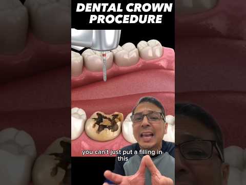 Restoring Worn Out Teeth with a Dental Crown (EXPLAINED) | View Mobile Dental